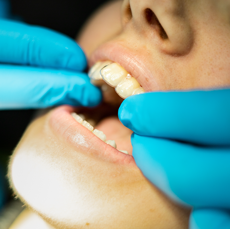 Cross Bite and Crowding – Fixed Braces London