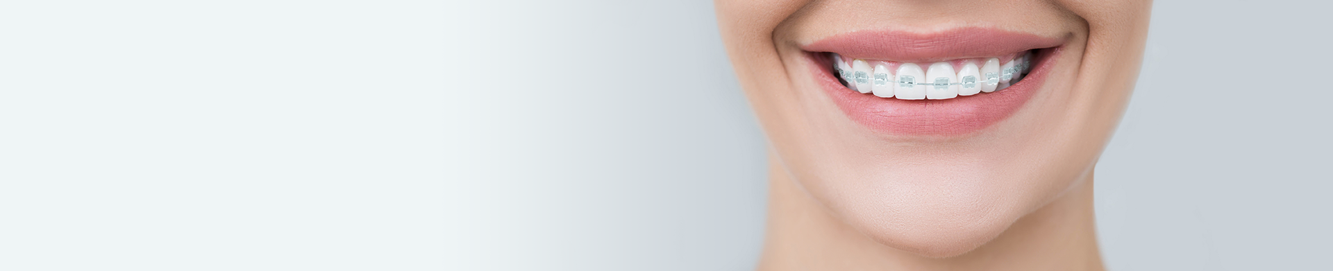 Fixed Braces for All Ages Banner - Fixed Braces London