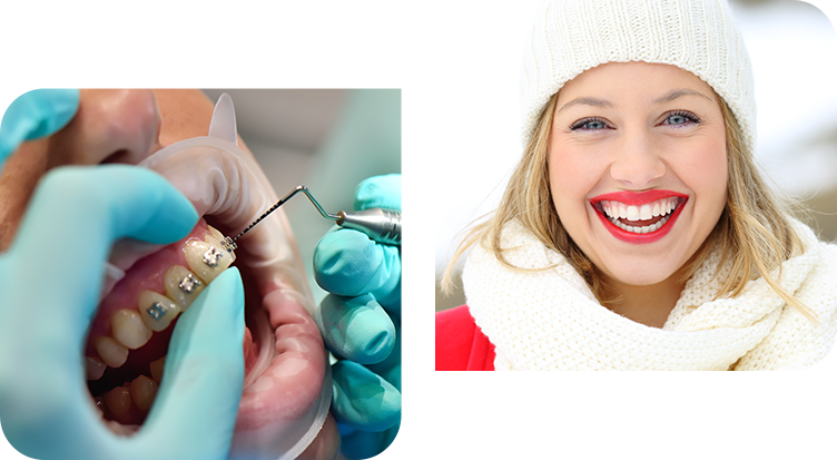 Fixed Braces for All Ages - Fixed Braces London