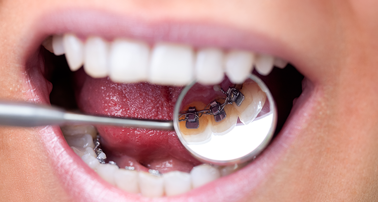 Lingual Braces Treatment - Fixed Braces London