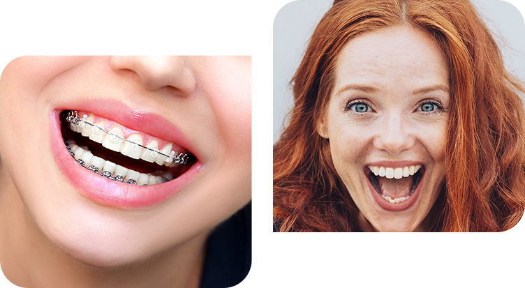 Our Case Studies – Fixed Braces London